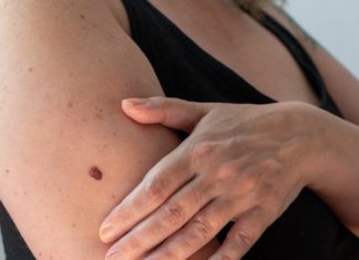 Das ABCDE-Schema: So lässt sich Hautkrebs frühzeitig erkennen Wer viele Pigmentmale auf der Haut hat, sollte diese regelmäßig untersuchen. / Source: Copyright (c) 2022 Delovely Pics/Shutterstock. No use without permission.